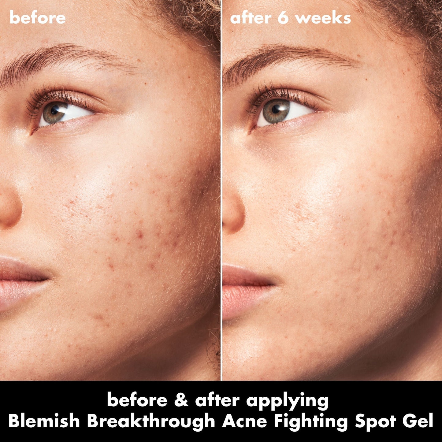 blemish-breakthrough-acne-fighting-spot-gel-m4 0326_EDU_BB_SpotGel_BA_MARLEY.jpg