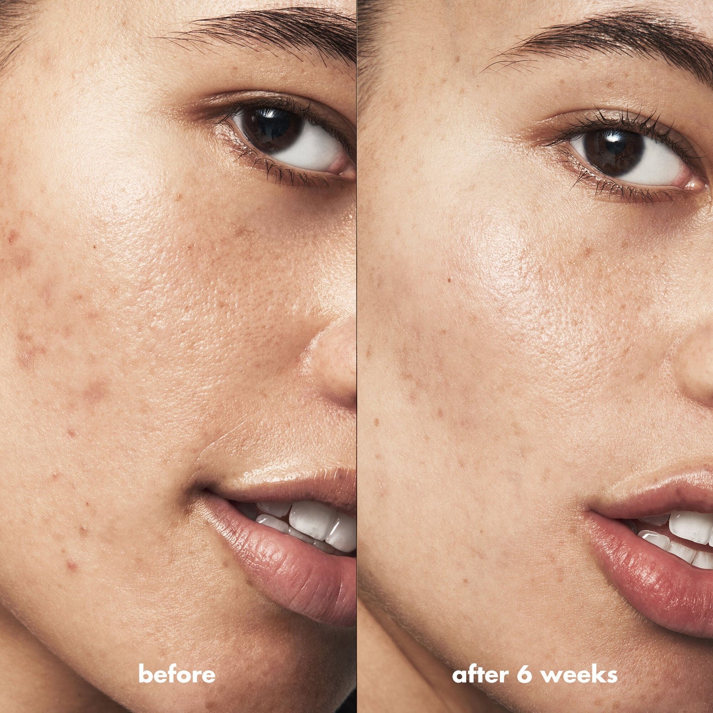 blemish-breakthrough-blemish-control-basics-kit-v9 Acne_PDP_Isabella_Before_After_0fcb9356-ae60-4e94-8953-6b1b2219dc49.jpg